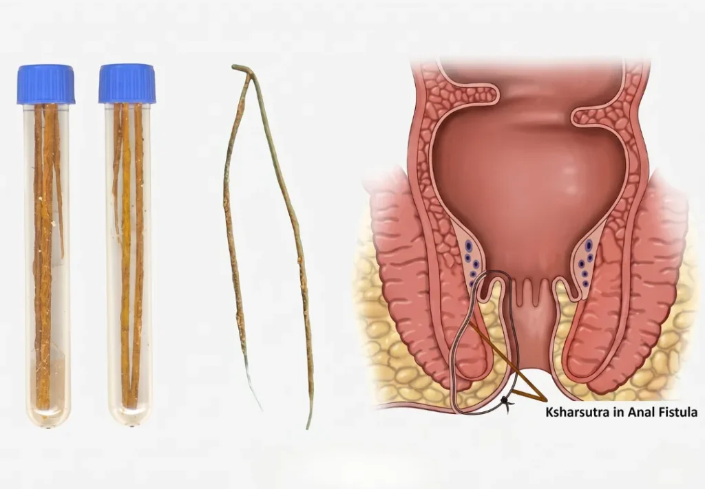 Advanced Ksharasutra Treatment in Ahmedabad