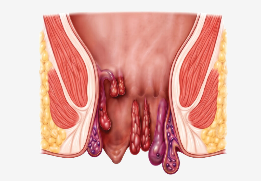 Advanced Piles Treatment in Ahmedabad